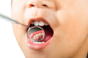 Multiple Teeth Dental Implants