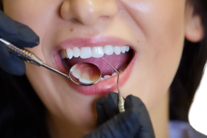 Full Mouth Dental Implants