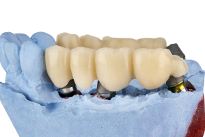 Implant-Supported Bridges and Crowns